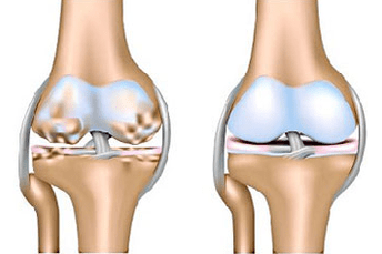 Healthy joint and osteoarthritis