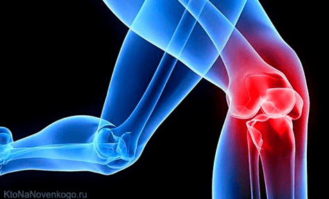 Osteoarthritis