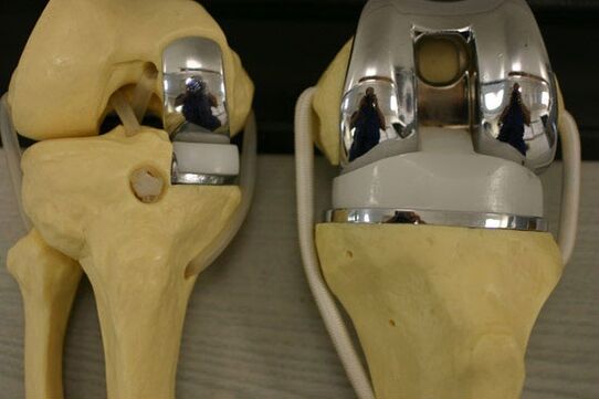Variants of the knee -articulation endoprothetics