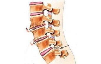 spondylartosis as causes of back pain