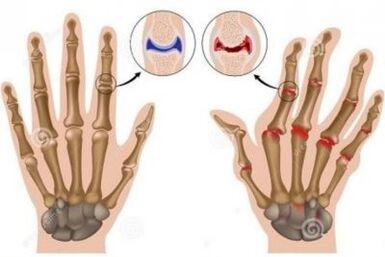 The causes of pain in finger joints