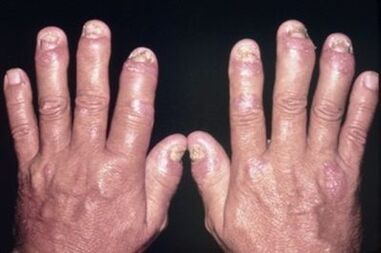 Why the finger joints hurt