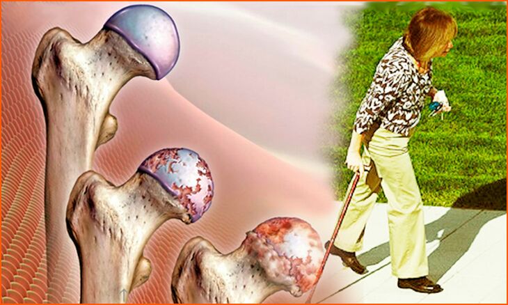Persistent lameness in the late stage of hip osteoarthritis