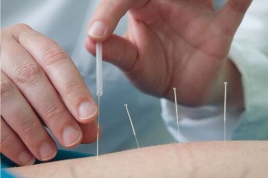Acupuncture is a method of treating pain in the lumbar region caused by osteochondrosis