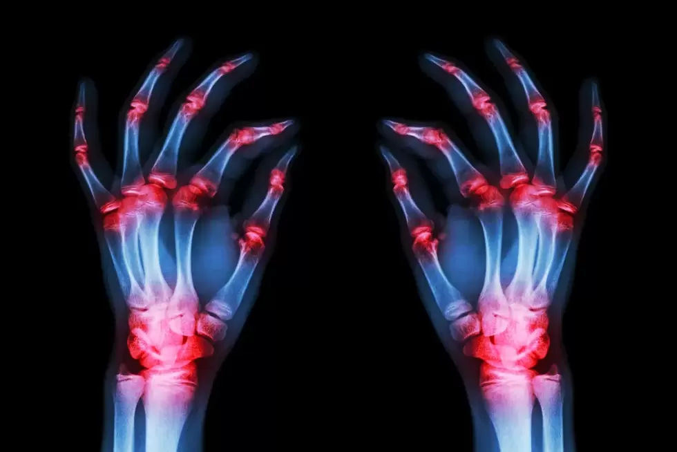 osteoarthritis of the finger joints