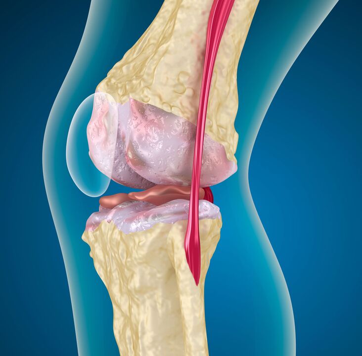 Arthrosis of the knee joint - a degenerative-dystrophic disease